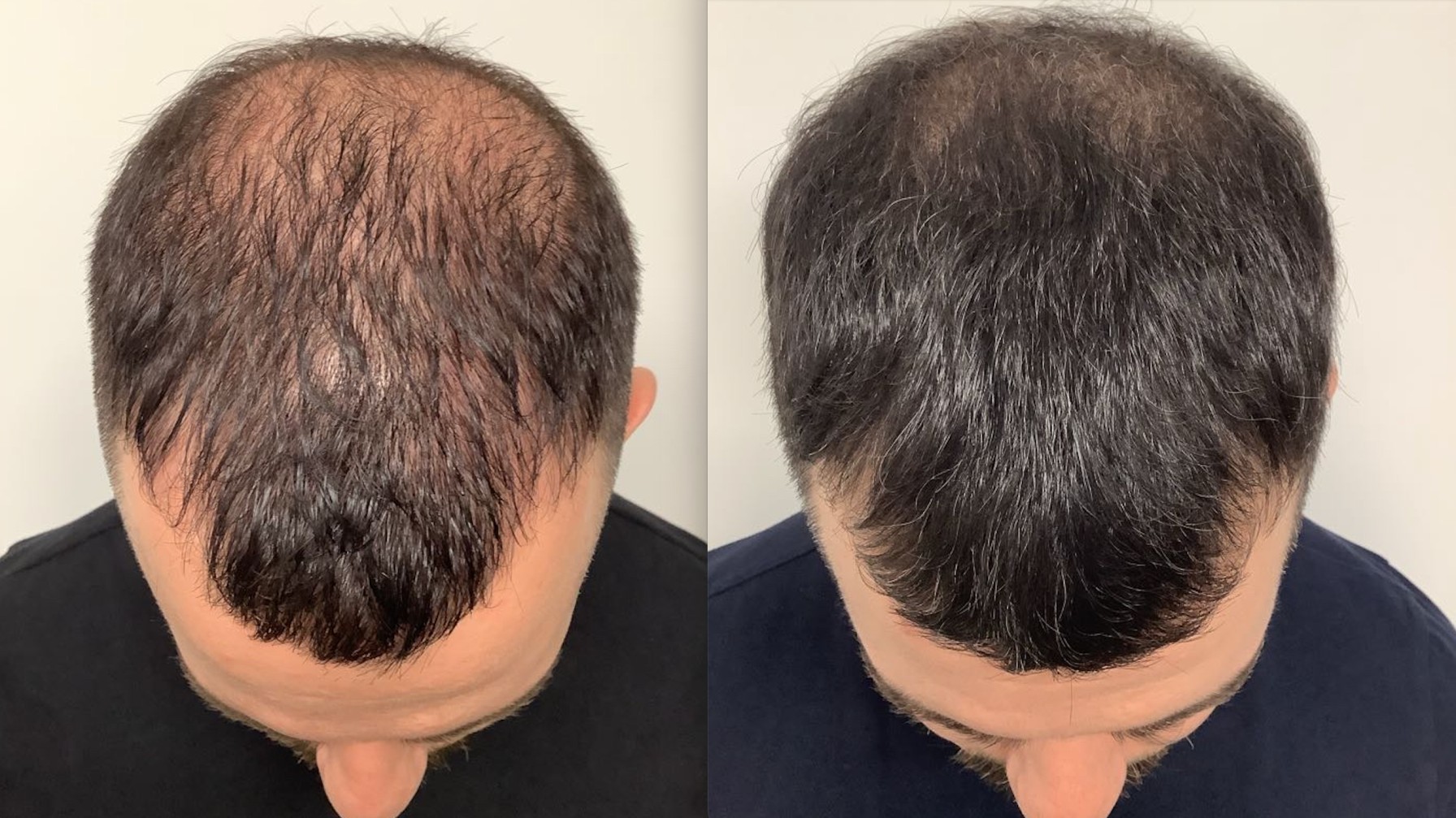 Brukey Says Este Medical Saved His Hair Este